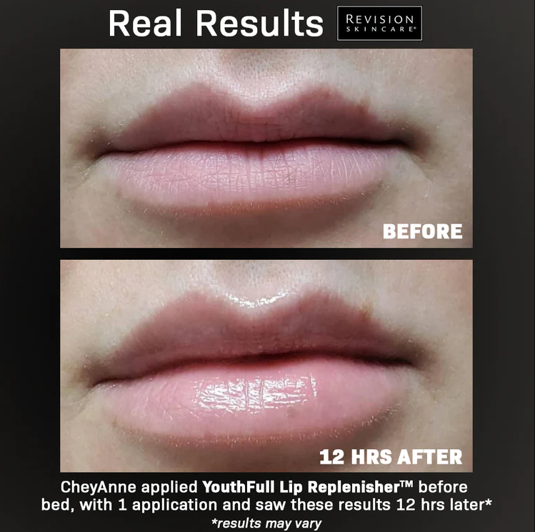 revision youthfull lip replenisher before and after photo