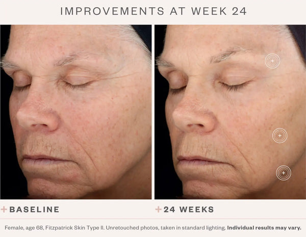 24 week skin improvement comparison when using SkinMedica TNS® Advanced+ Serum